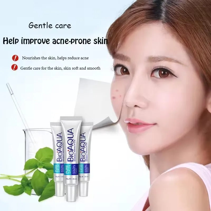 Acne Removal Cream – Anti Pimple & Dark Spot Treatment for Clear Skin