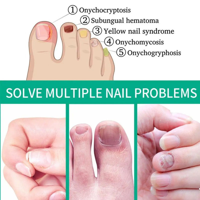 Nail Fungus Remover – Anti Fungal Nail Treatment Solution