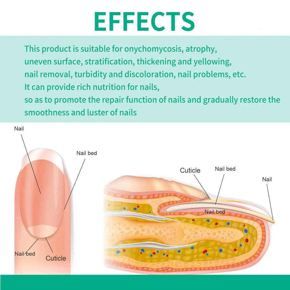 Nail Fungus Remover – Anti Fungal Nail Treatment Solution