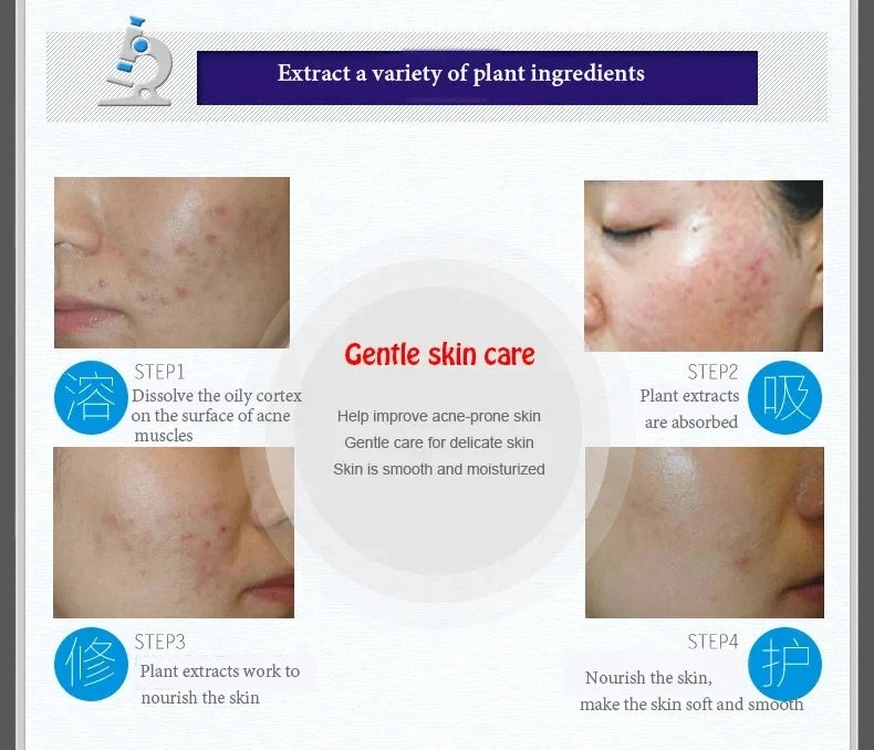 Acne Removal Cream – Anti Pimple & Dark Spot Treatment for Clear Skin