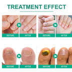 Nail Fungus Remover – Anti Fungal Nail Treatment Solution