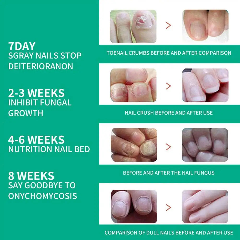 Nail Fungus Remover – Anti Fungal Nail Treatment Solution
